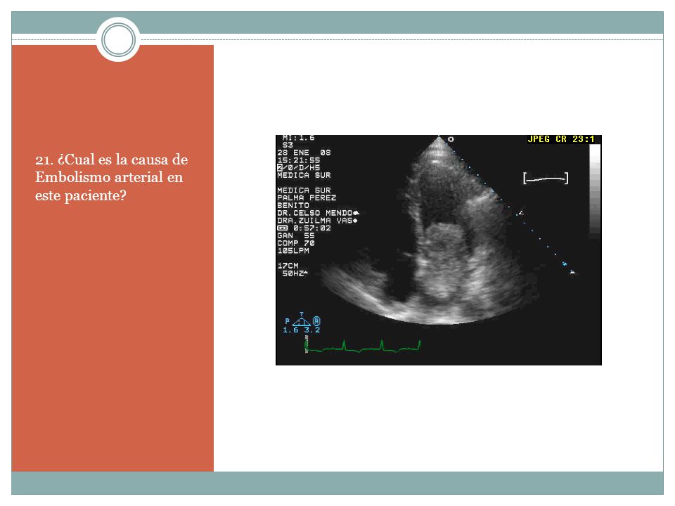 21. ¿Cual es la causa de Embolismo arterial en este paciente