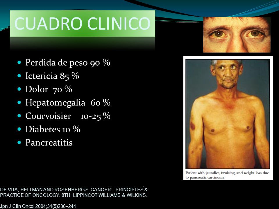 CUADRO CLINICO Perdida de peso 90 % Ictericia 85 % Dolor 70 %