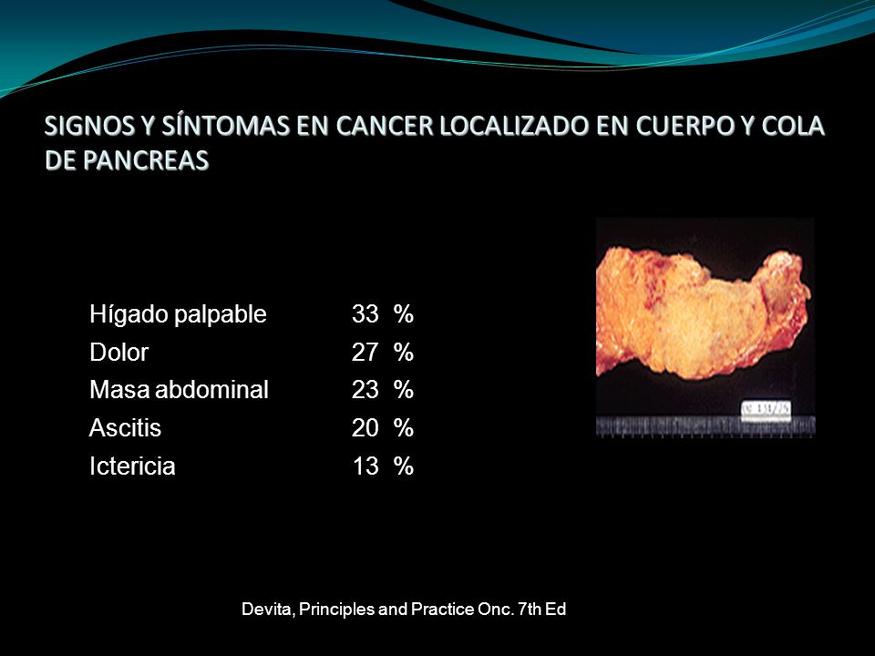 SIGNOS Y SÍNTOMAS EN CANCER LOCALIZADO EN CUERPO Y COLA DE PANCREAS