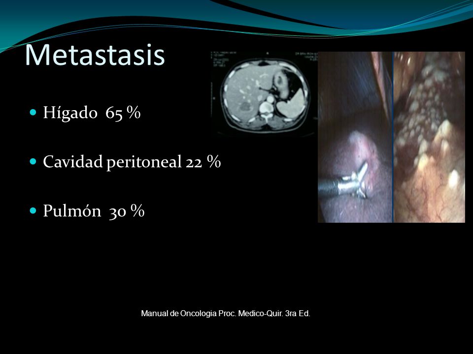 Metastasis Hígado 65 % Cavidad peritoneal 22 % Pulmón 30 %