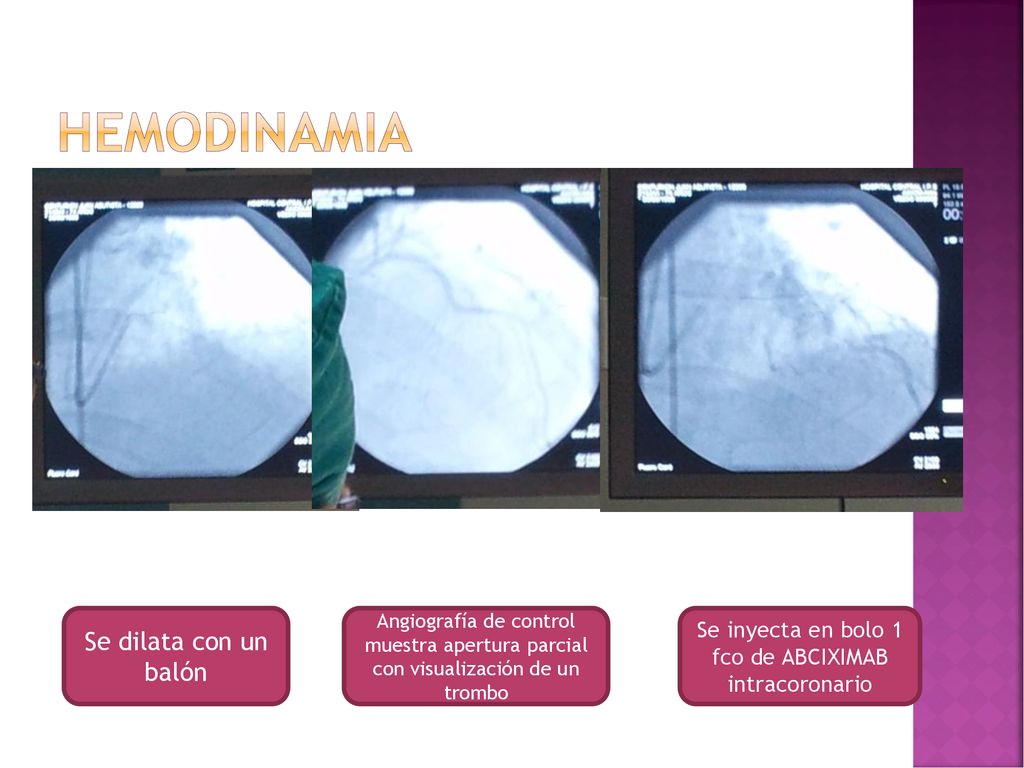 Se inyecta en bolo 1 fco de ABCIXIMAB intracoronario