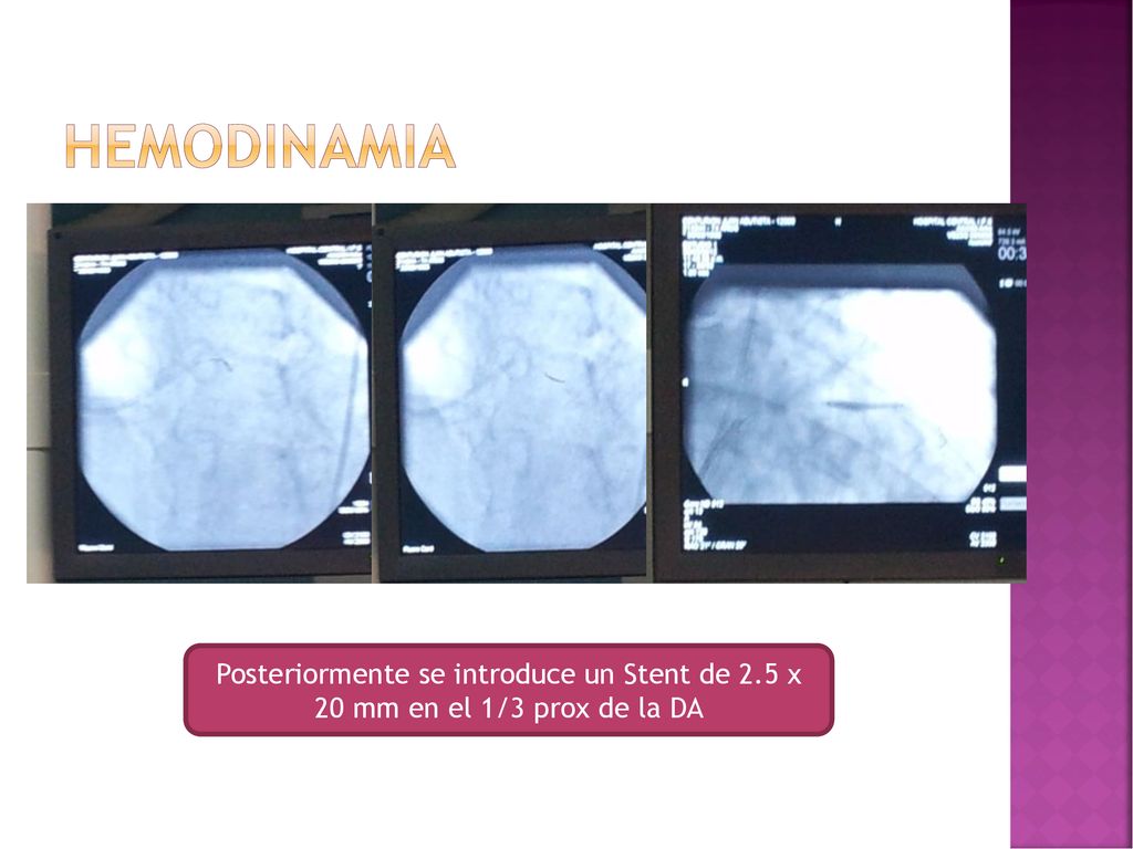 hemodinamia Posteriormente se introduce un Stent de 2.5 x 20 mm en el 1/3 prox de la DA