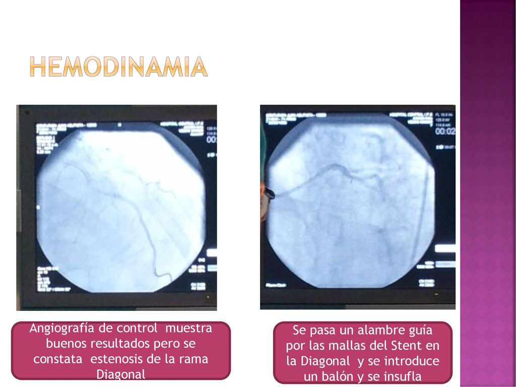 hemodinamia Angiografía de control muestra buenos resultados pero se constata estenosis de la rama Diagonal.