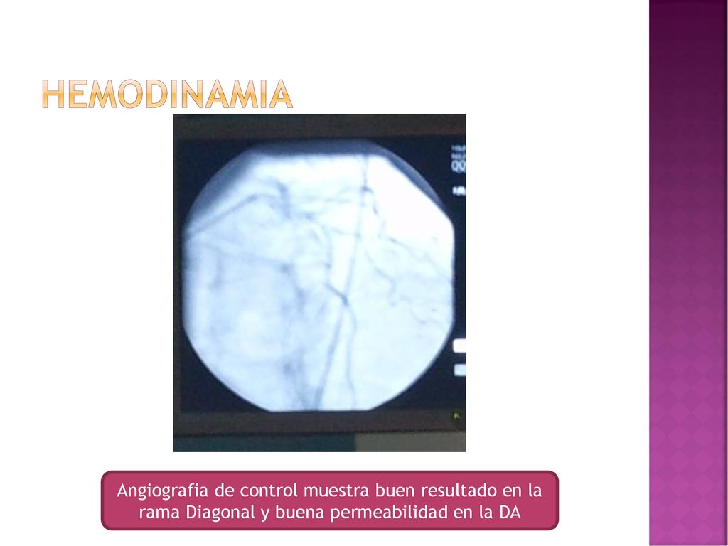 hemodinamia Angiografia de control muestra buen resultado en la rama Diagonal y buena permeabilidad en la DA.