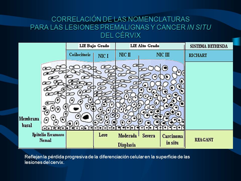 CORRELACIÓN DE LAS NOMENCLATURAS PARA LAS LESIONES PREMALIGNAS Y CANCER IN SITU DEL CÉRVIX