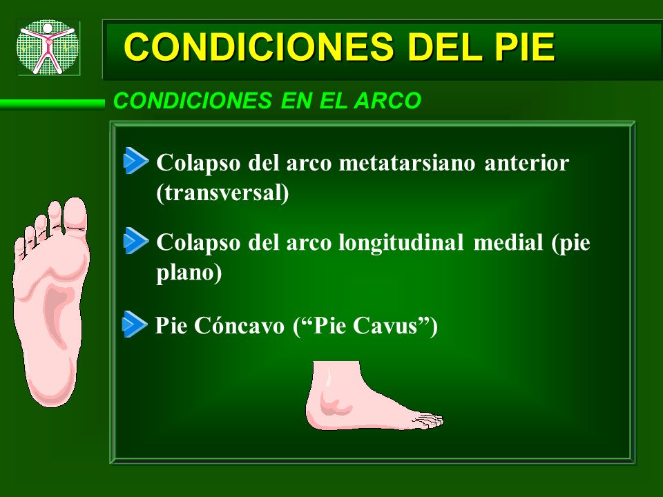 CONDICIONES DEL PIE CONDICIONES EN EL ARCO. Colapso del arco metatarsiano anterior (transversal) Colapso del arco longitudinal medial (pie plano)