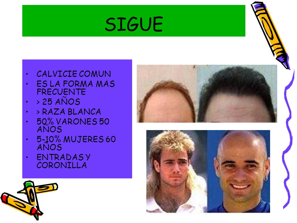 SIGUE CALVICIE COMUN ES LA FORMA MAS FRECUENTE > 25 AÑOS