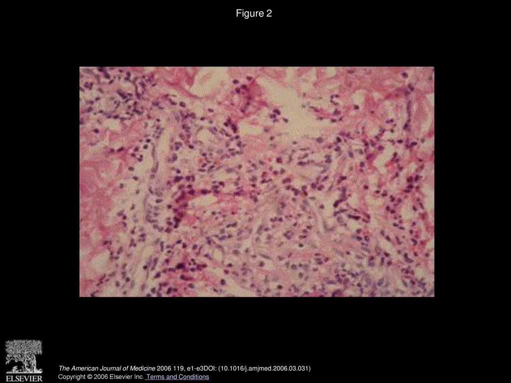 Figure 2 (40 X) Leukocytoclastic vasculitis with prominent eosinophils and fibrin deposits on the vessel wall.