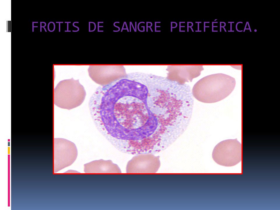 FROTIS DE SANGRE PERIFÉRICA.