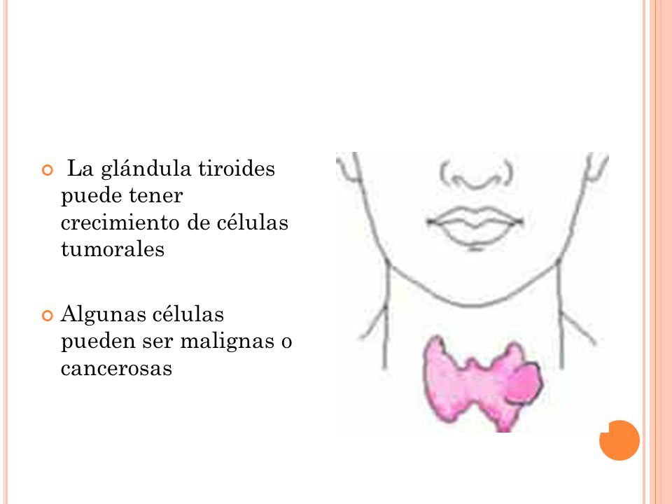 La glándula tiroides puede tener crecimiento de células tumorales