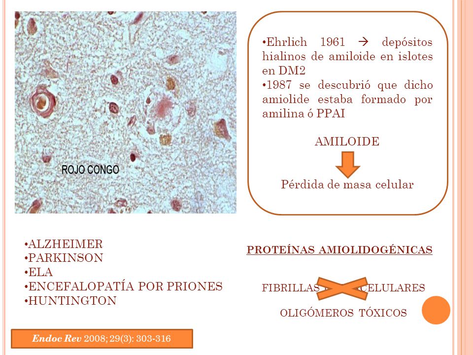 Ehrlich 1961  depósitos hialinos de amiloide en islotes en DM2