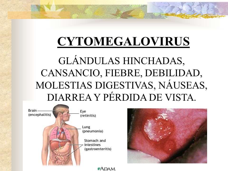 CYTOMEGALOVIRUS GLÁNDULAS HINCHADAS, CANSANCIO, FIEBRE, DEBILIDAD, MOLESTIAS DIGESTIVAS, NÁUSEAS, DIARREA Y PÉRDIDA DE VISTA.