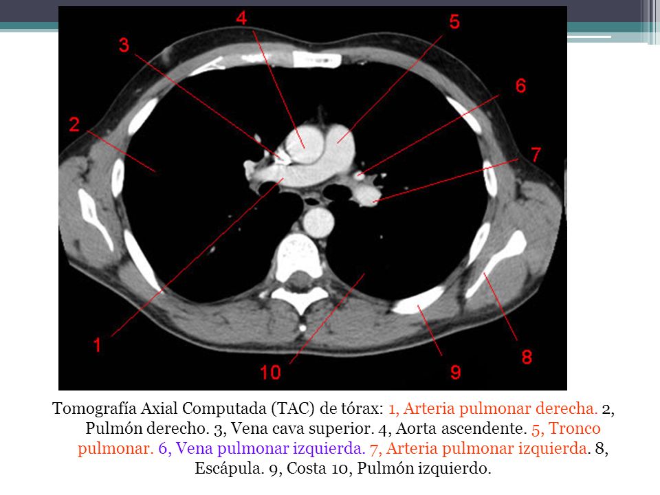 Tomografía Axial Computada (TAC) de tórax: 1, Arteria pulmonar derecha