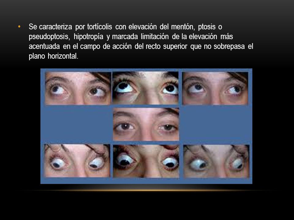 Se caracteriza por tortícolis con elevación del mentón, ptosis o pseudoptosis, hipotropía y marcada limitación de la elevación más acentuada en el campo de acción del recto superior que no sobrepasa el plano horizontal.