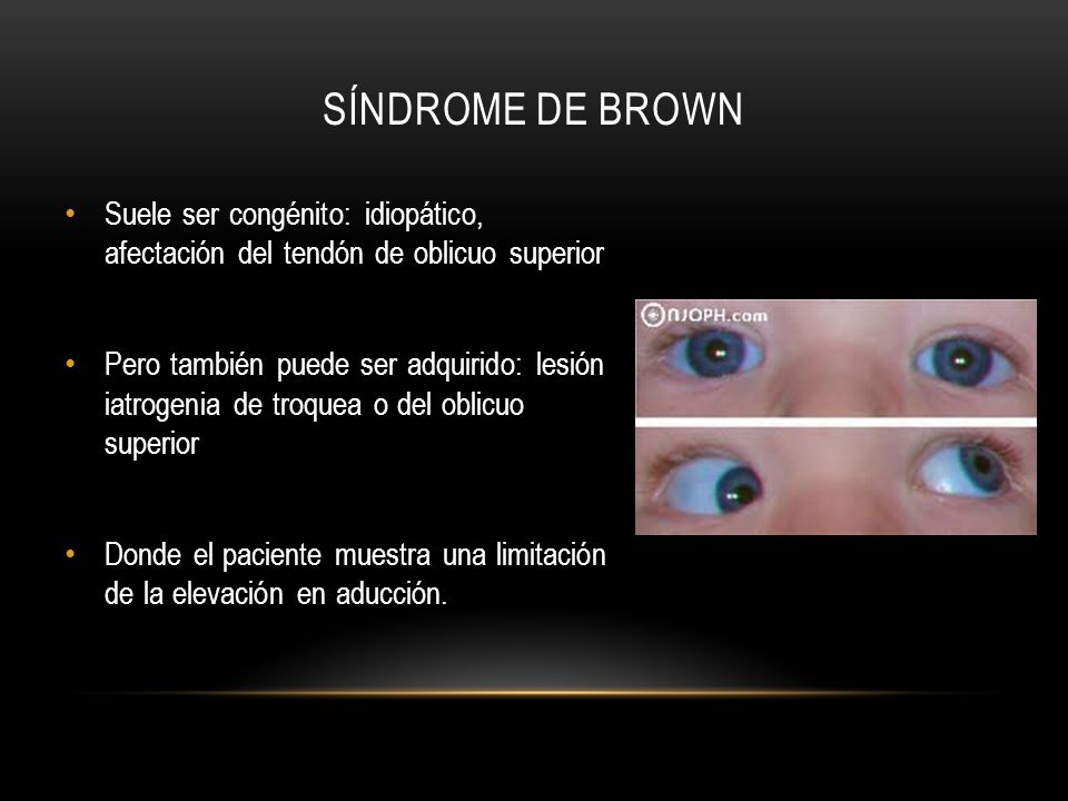 Síndrome de Brown Suele ser congénito: idiopático, afectación del tendón de oblicuo superior.