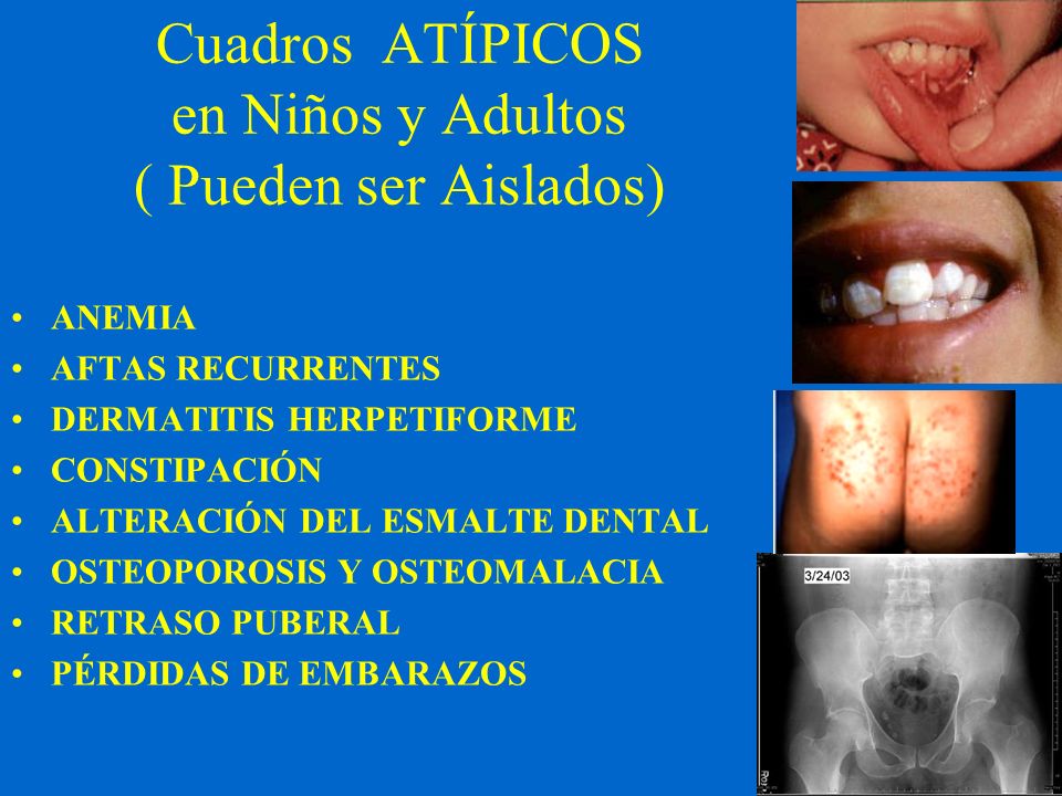 Cuadros ATÍPICOS en Niños y Adultos ( Pueden ser Aislados)