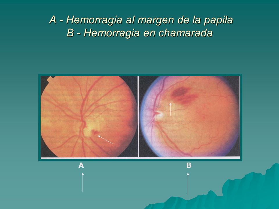 A - Hemorragia al margen de la papila B - Hemorragia en chamarada