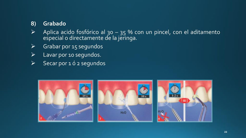 Grabado Aplica acido fosfórico al 30 – 35 % con un pincel, con el aditamento especial o directamente de la jeringa.