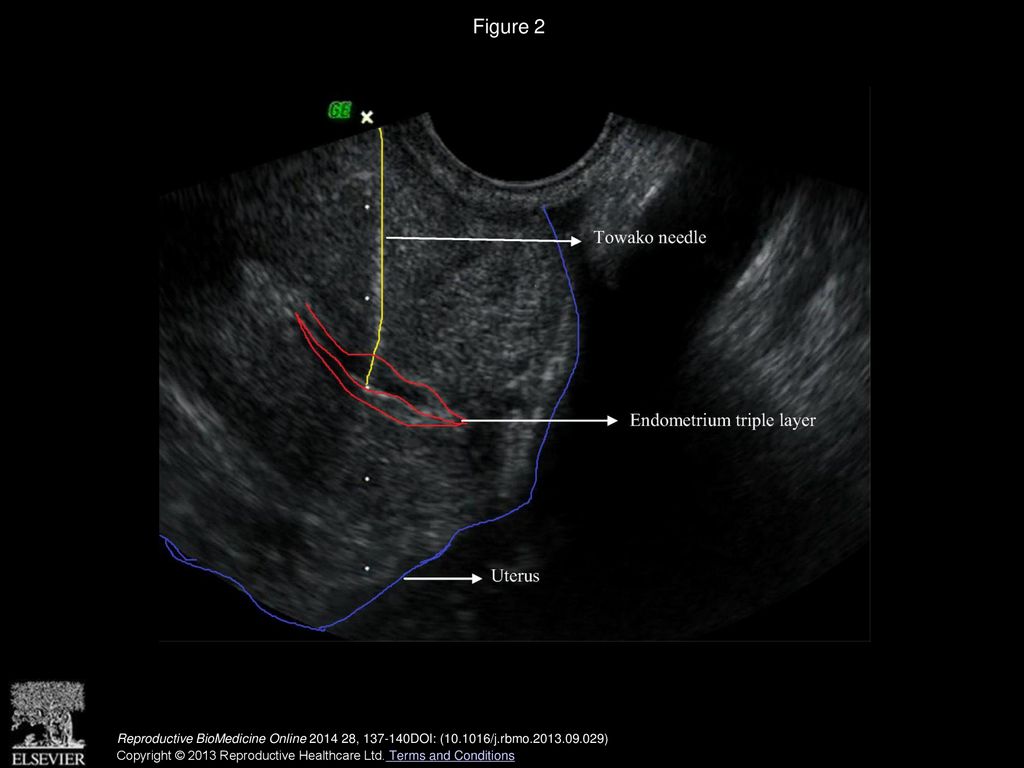Figure 2 Ultrasound documentation: insertion of the Towako needle through the endometrium.
