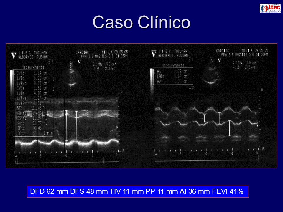 Caso Clínico DFD 62 mm DFS 48 mm TIV 11 mm PP 11 mm AI 36 mm FEVI 41%
