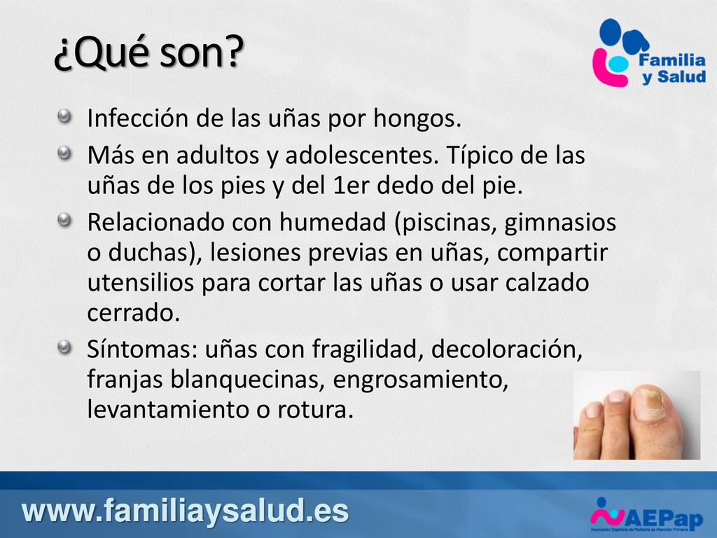 ¿Qué son   Infección de las uñas por hongos.