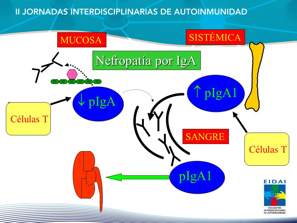  pIgA1 Nefropatía por IgA  pIgA pIgA1 SISTÉMICA MUCOSA Células T