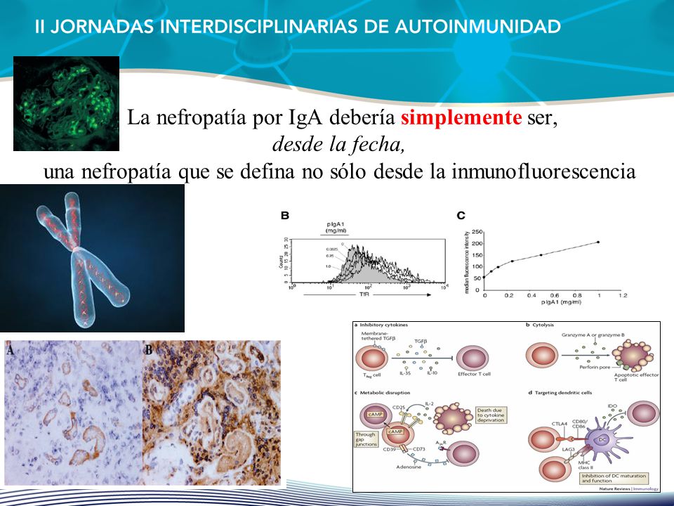 La nefropatía por IgA debería simplemente ser, desde la fecha, una nefropatía que se defina no sólo desde la inmunofluorescencia