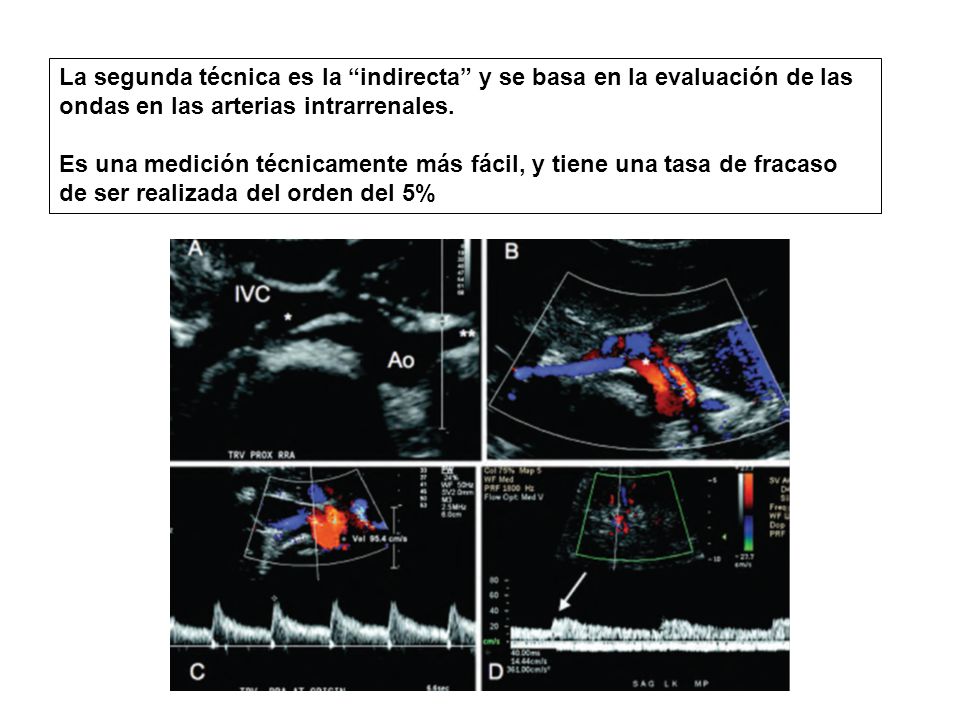 La segunda técnica es la indirecta y se basa en la evaluación de las ondas en las arterias intrarrenales.