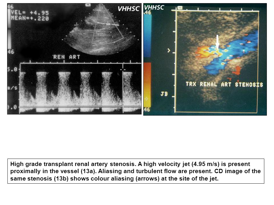 High grade transplant renal artery stenosis. A high velocity jet (4