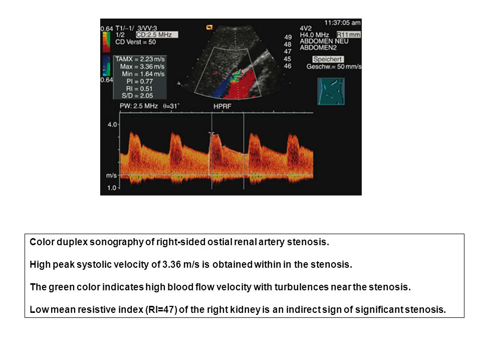 Color duplex sonography of right-sided ostial renal artery stenosis.