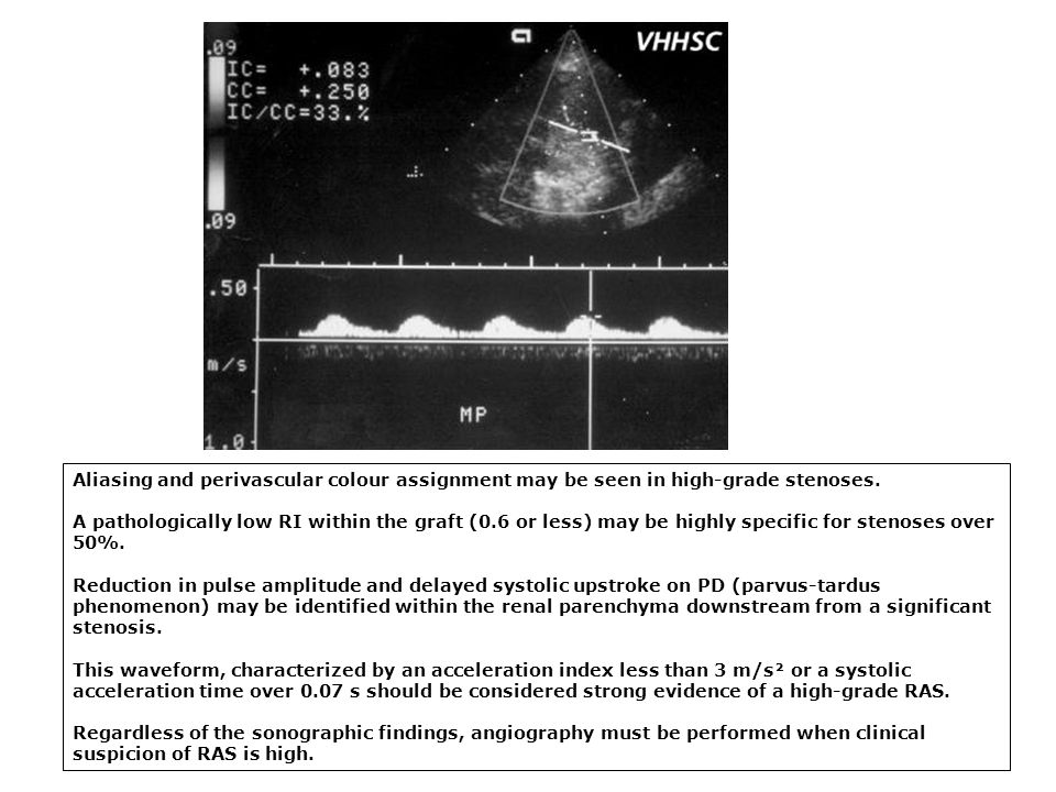 Aliasing and perivascular colour assignment may be seen in high-grade stenoses.