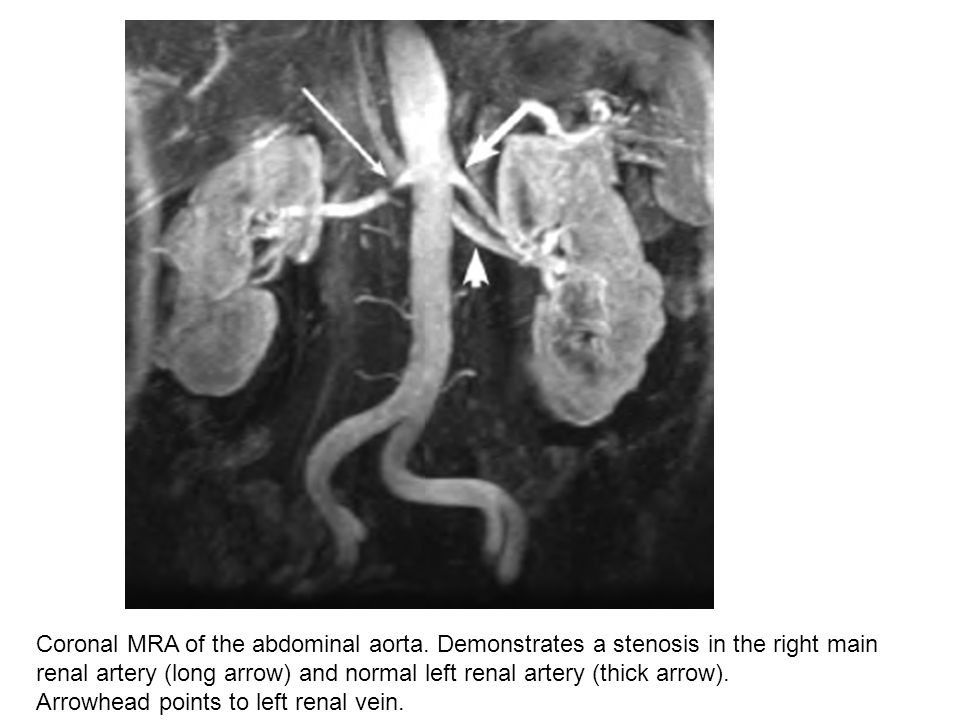 Coronal MRA of the abdominal aorta
