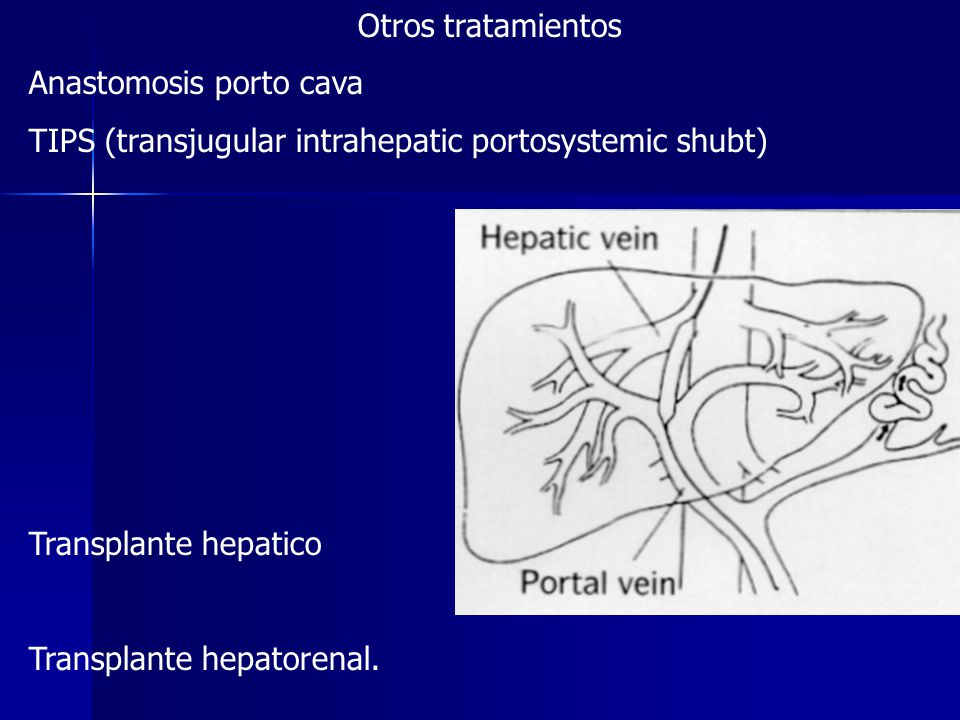 Otros tratamientos Anastomosis porto cava. TIPS (transjugular intrahepatic portosystemic shubt) Transplante hepatico.