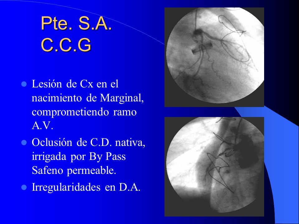 Pte. S.A. C.C.G Lesión de Cx en el nacimiento de Marginal, comprometiendo ramo A.V. Oclusión de C.D. nativa, irrigada por By Pass Safeno permeable.