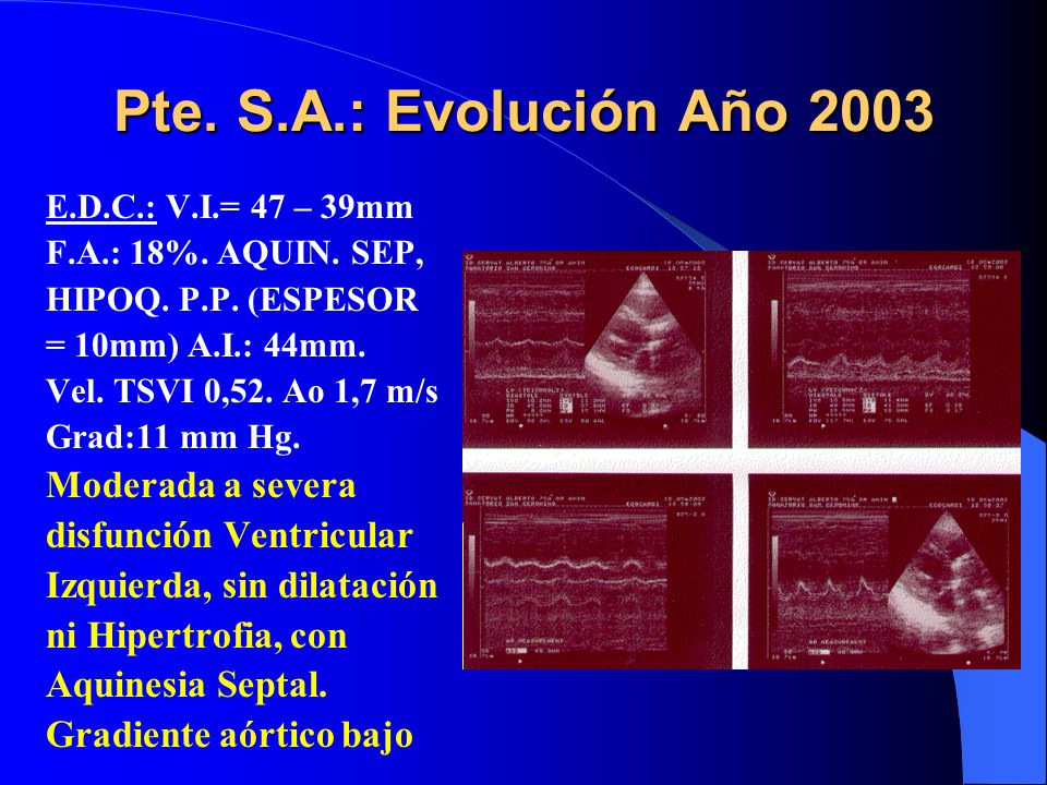 Pte. S.A.: Evolución Año 2003 Moderada a severa disfunción Ventricular