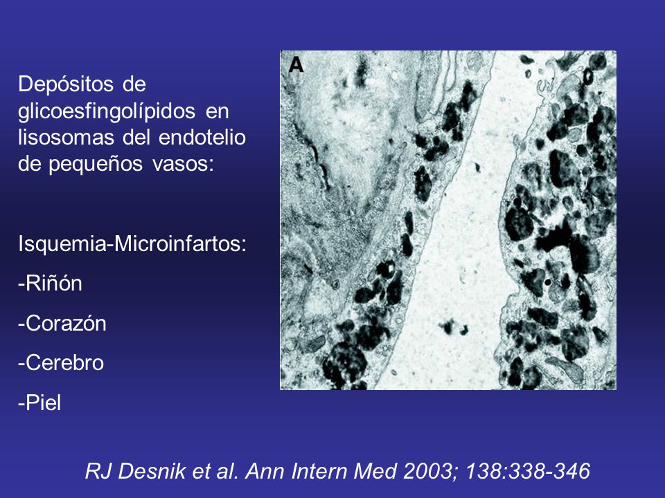 Depósitos de glicoesfingolípidos en lisosomas del endotelio de pequeños vasos: