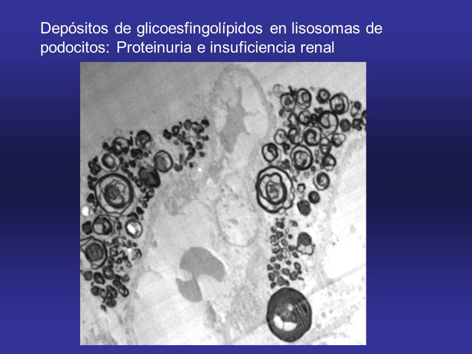 Depósitos de glicoesfingolípidos en lisosomas de podocitos: Proteinuria e insuficiencia renal