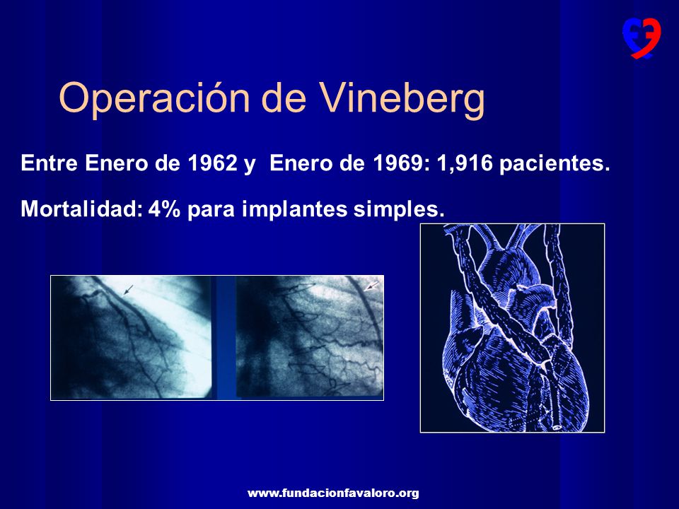 Operación de Vineberg Entre Enero de 1962 y Enero de 1969: 1,916 pacientes.