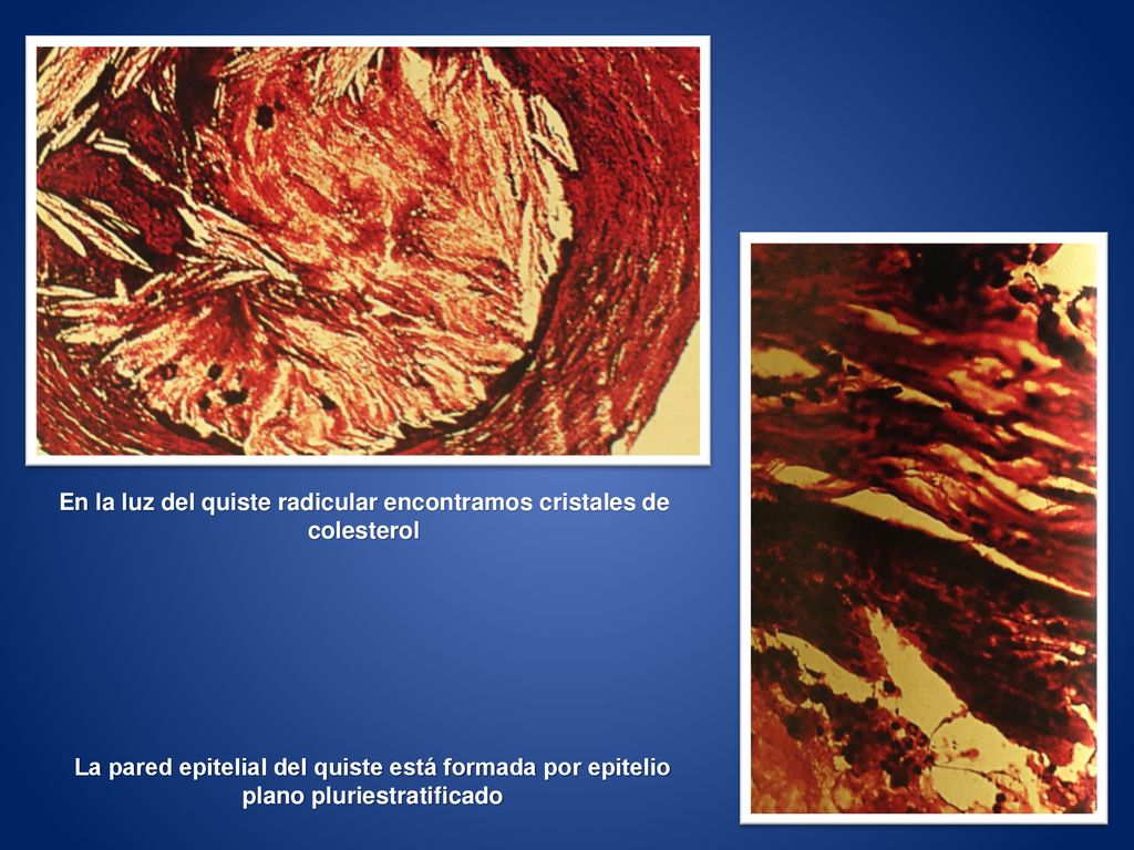 En la luz del quiste radicular encontramos cristales de colesterol