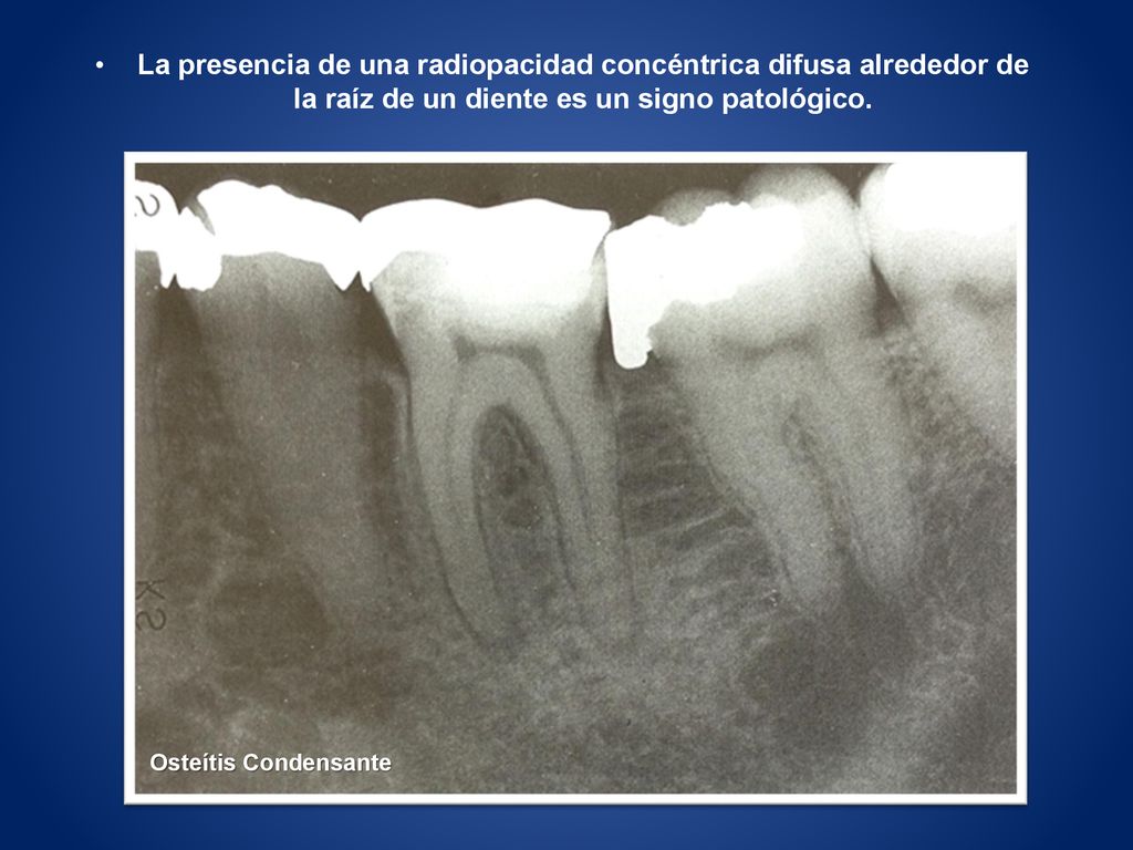 La presencia de una radiopacidad concéntrica difusa alrededor de la raíz de un diente es un signo patológico.