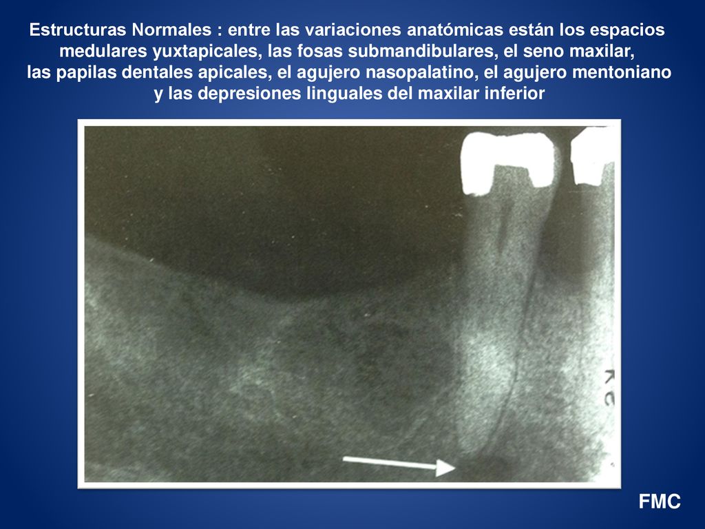 Estructuras Normales : entre las variaciones anatómicas están los espacios