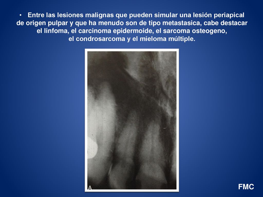 Entre las lesiones malignas que pueden simular una lesión periapical