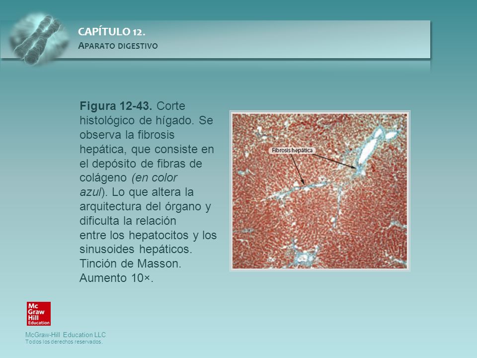 Figura Corte histológico de hígado. Se observa la fibrosis