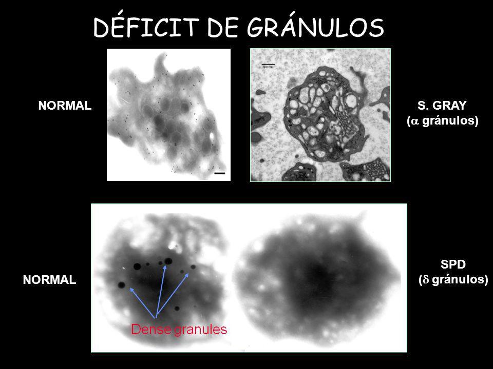 DÉFICIT DE GRÁNULOS NORMAL S. GRAY ( gránulos) SPD ( gránulos)