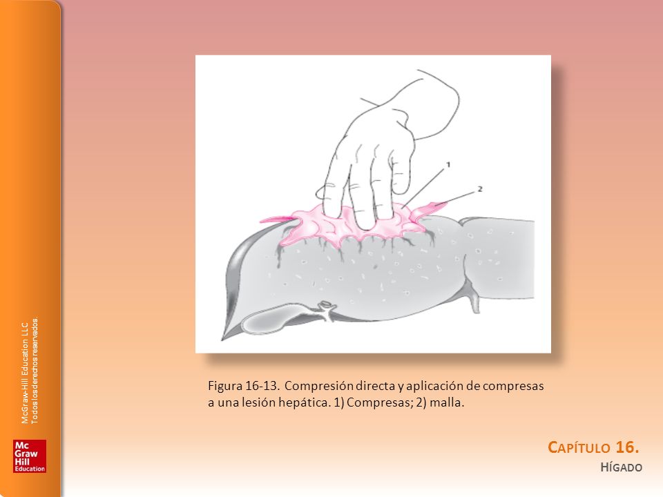 Figura Compresión directa y aplicación de compresas a una lesión hepática.