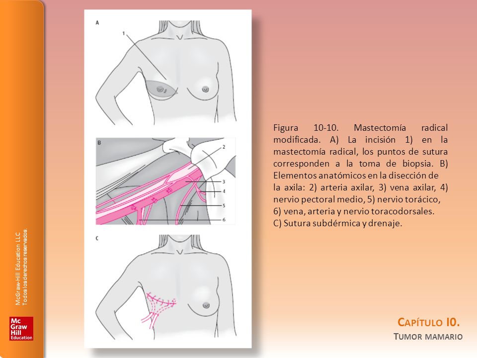 Figura Mastectomía radical modificada