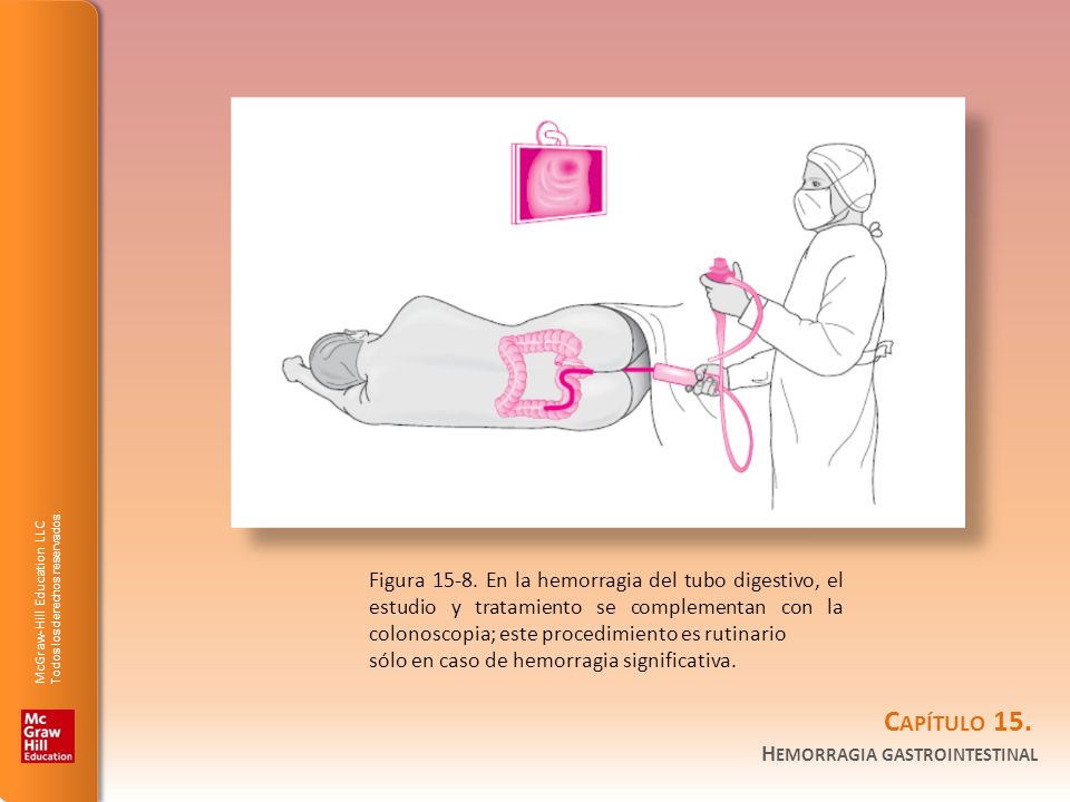 Figura En la hemorragia del tubo digestivo, el estudio y tratamiento se complementan con la colonoscopia; este procedimiento es rutinario