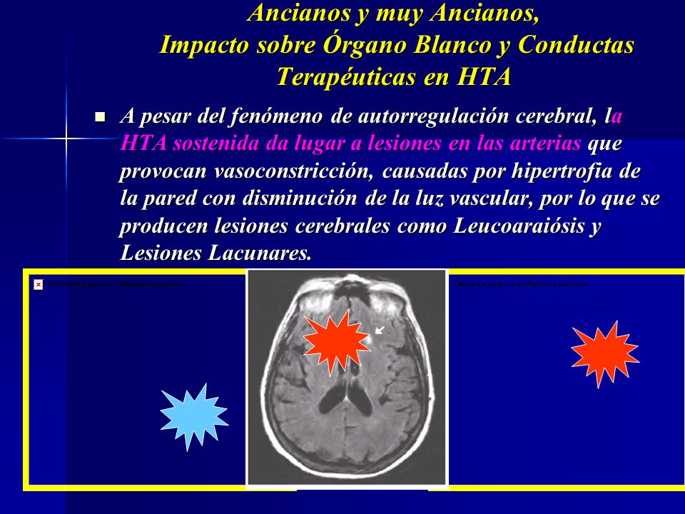 Ancianos y muy Ancianos, Impacto sobre Órgano Blanco y Conductas Terapéuticas en HTA
