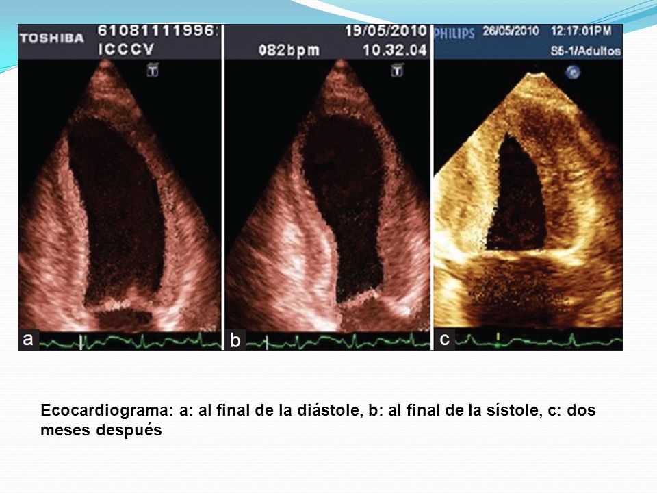 Ecocardiograma: a: al final de la diástole, b: al final de la sístole, c: dos meses después