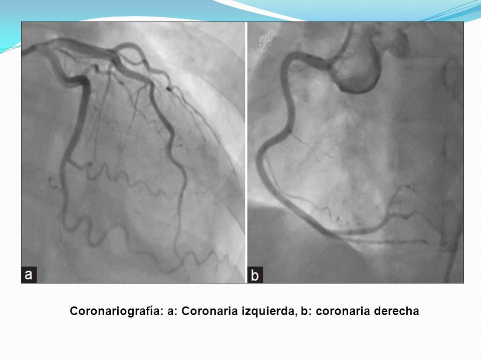Coronariografía: a: Coronaria izquierda, b: coronaria derecha